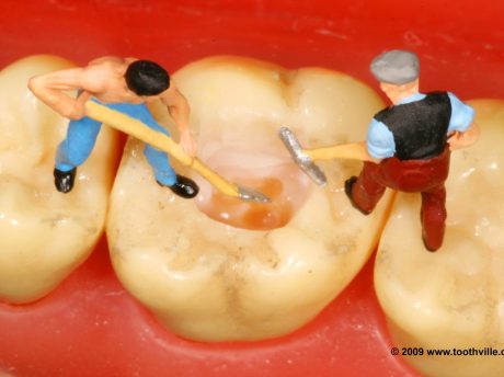 Why We Sometimes Don’t Fill the Hole on Your X-Ray