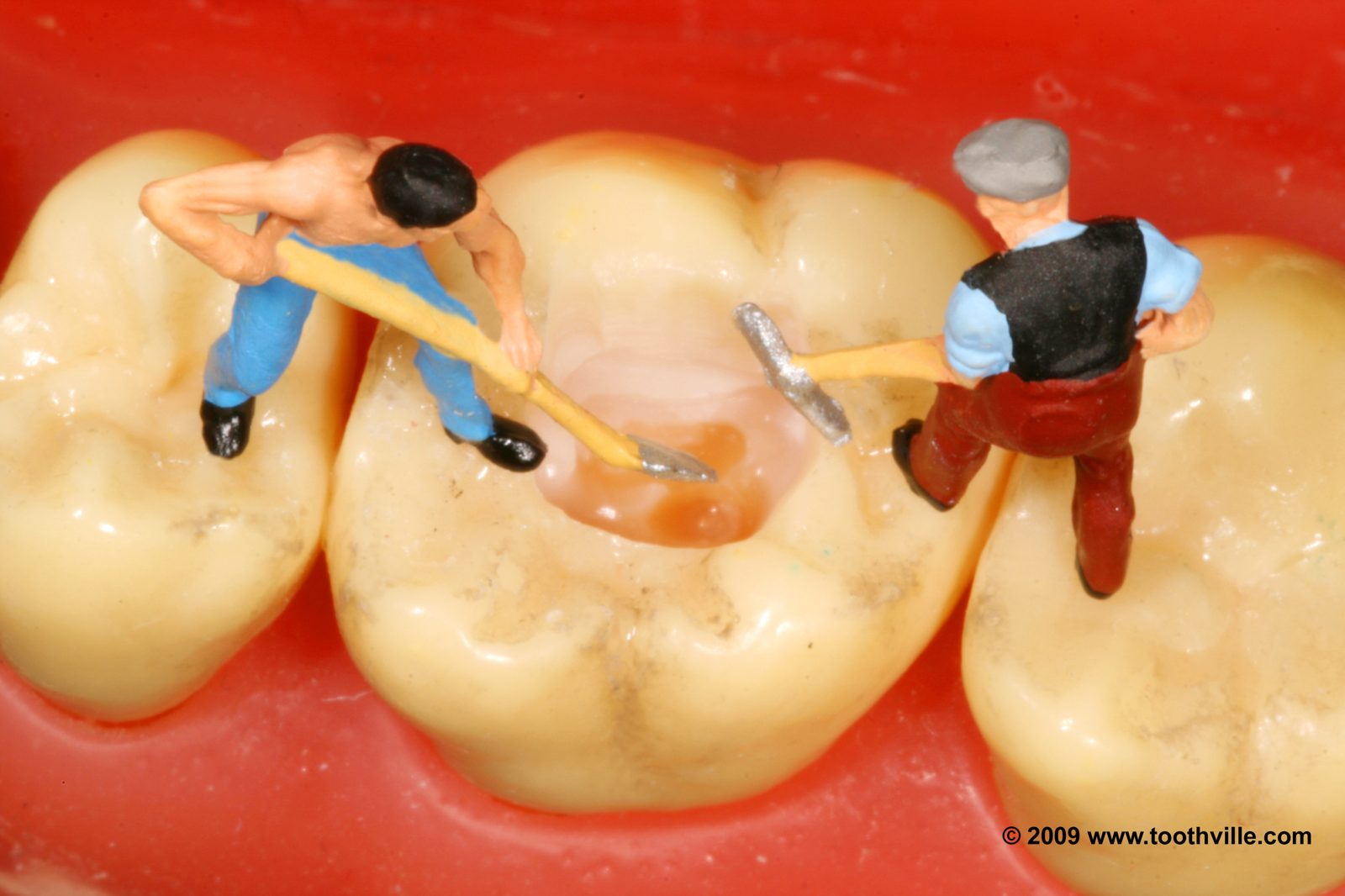 Cavity Preparation