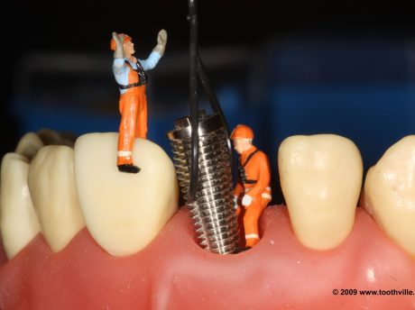 Same-Day Crowns: How CEREC Lets You Walk Out With a Finished Crown