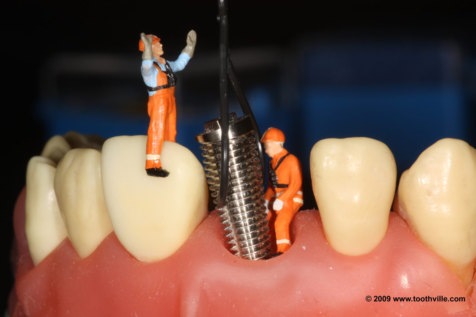 Implant Placement