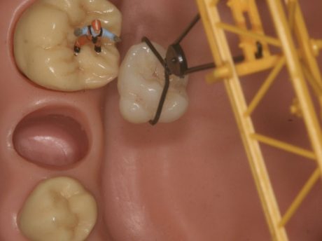 What a Root Canal Actually Is — A Plain English Guide
