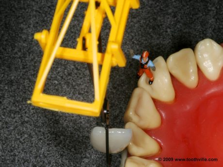 My Approach to Veneers: Taking Away As Little As Possible