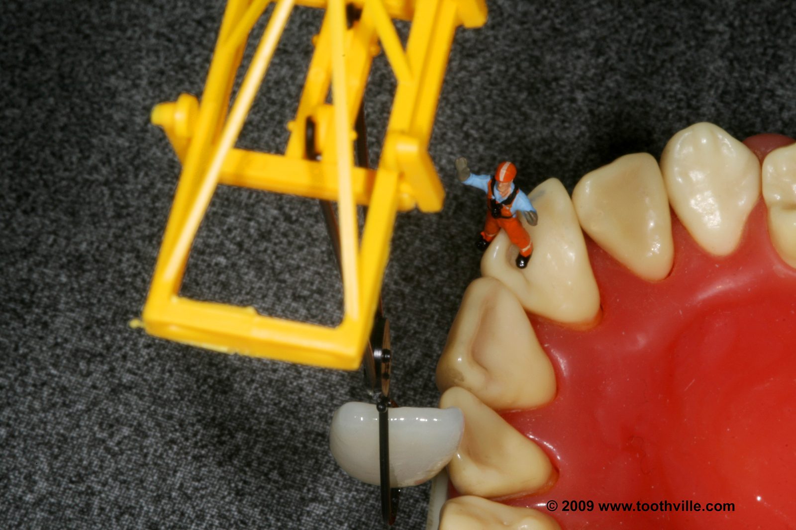 Veneer Placement